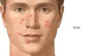 el acné en el hombre